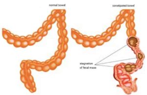 Constipation-Diagram