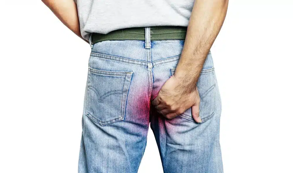 Painless piles, hemorrhoid treatment in Indore