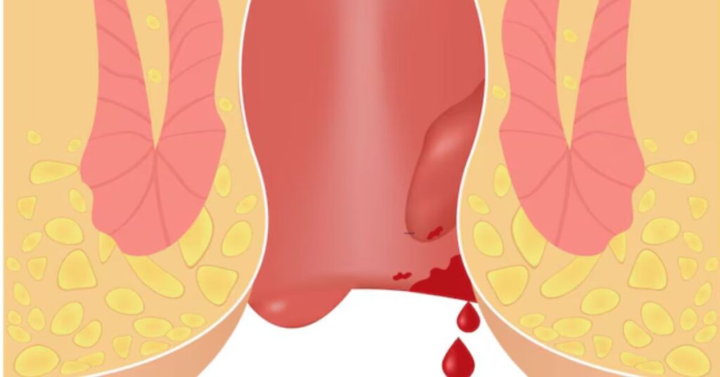 best doctor for piles in indore